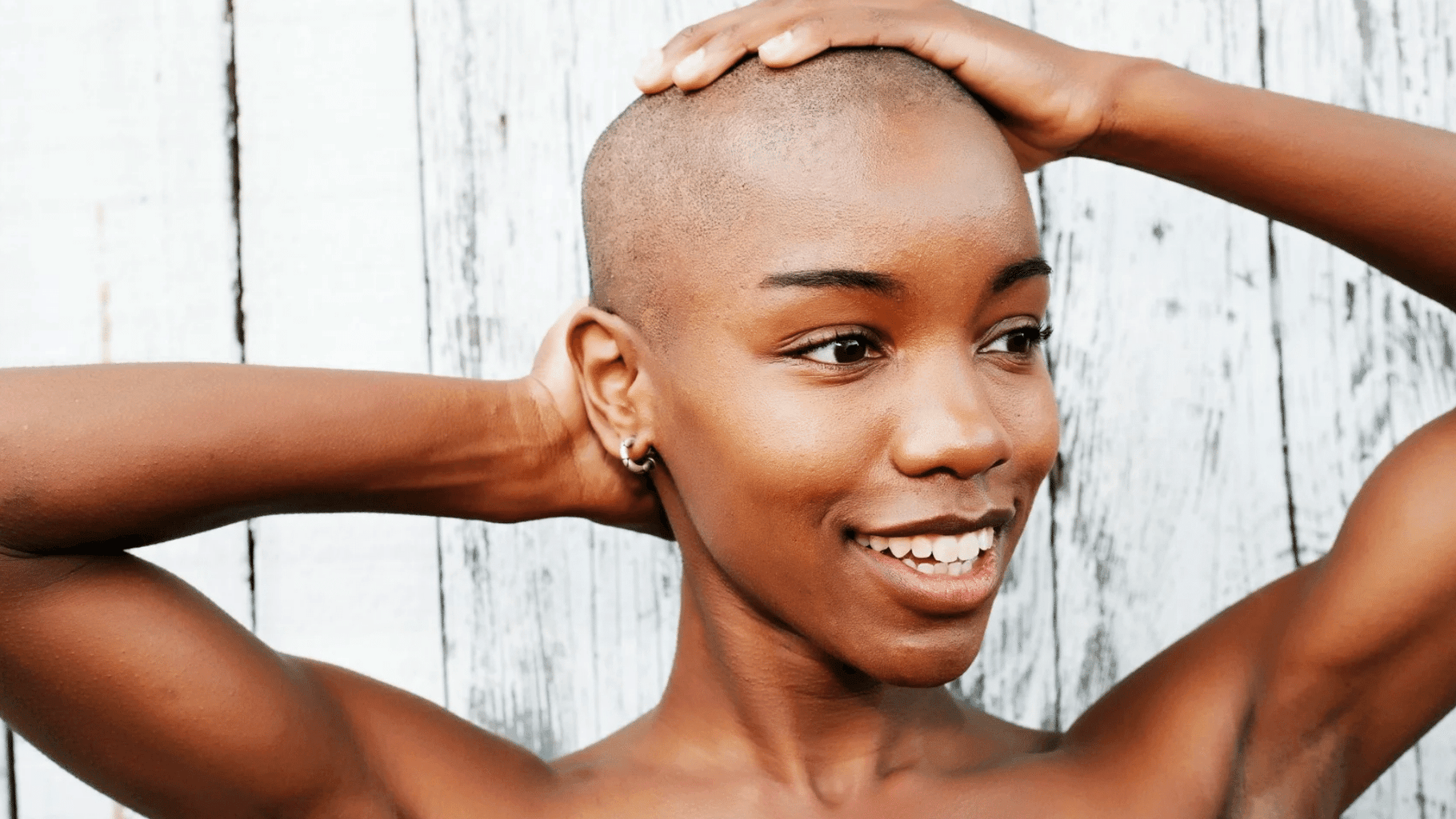 Alopecia Areata