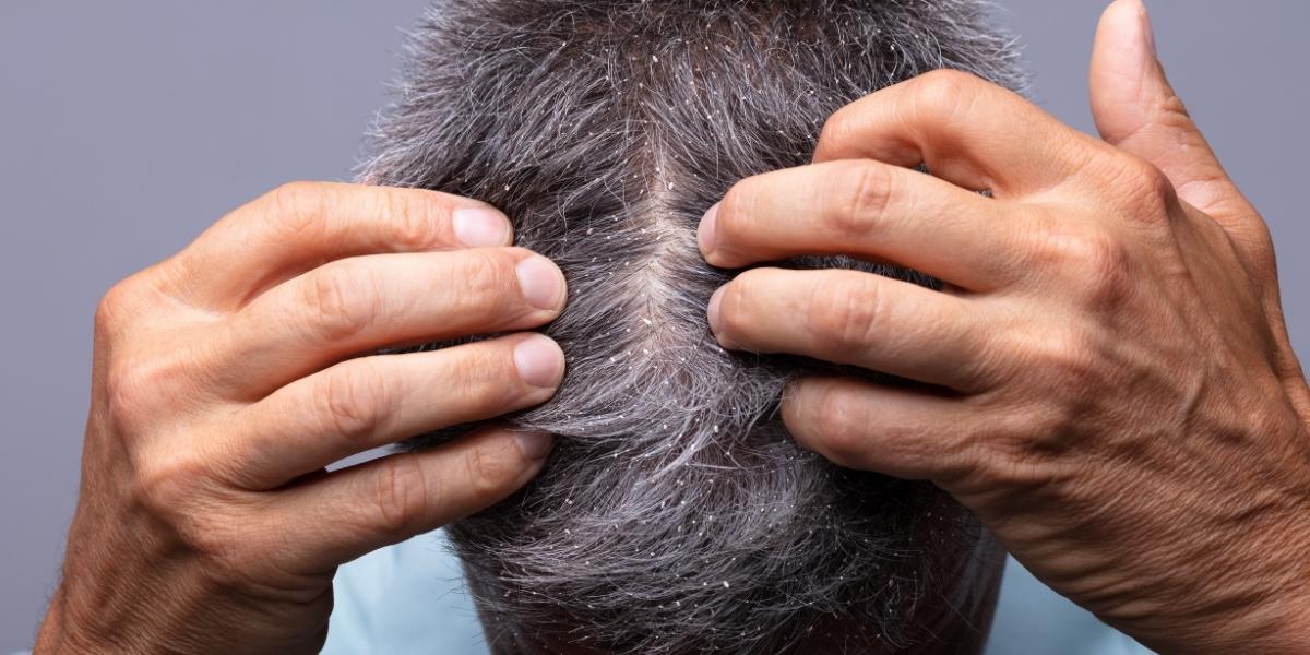 Flakes on the scalp, but not dandruff?