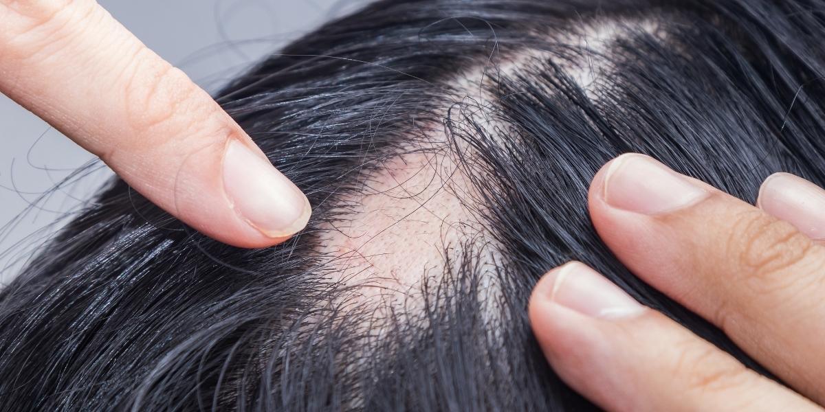 Noticed a bald spot on your head? Here’s what to do next