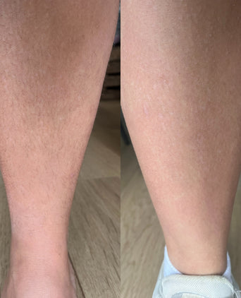 Keramene body hair minimizer ihokarvojenpoistovoide