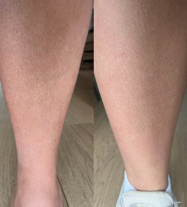 Keramene body hair minimizer ihokarvojenpoistovoide