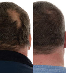 Foligain hair growth treatment (men)