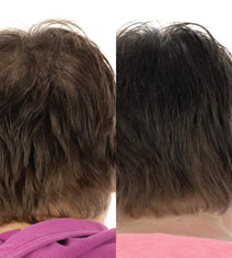 Foligain hair growth treatment (women)